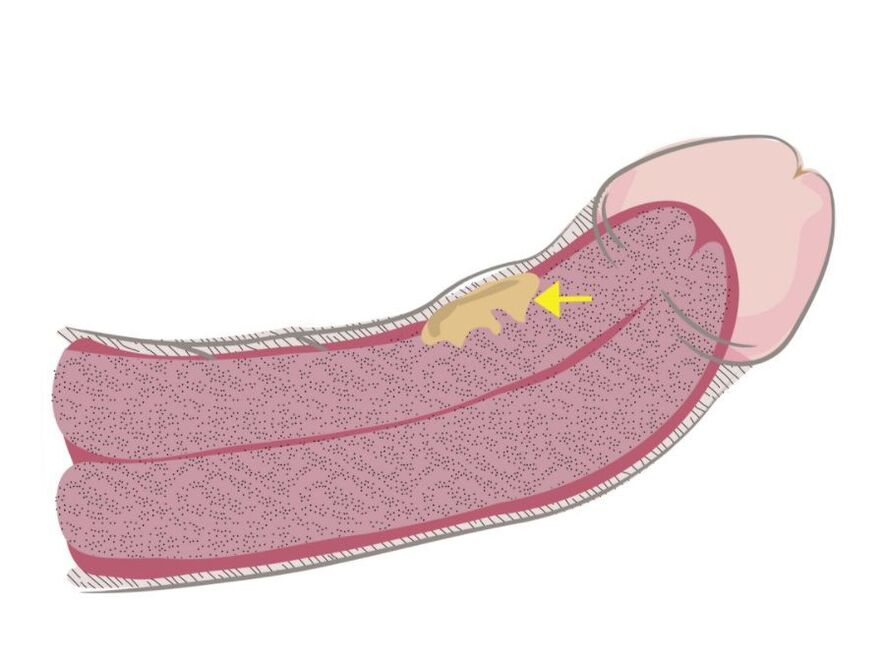 fibrous plaques on the penis
